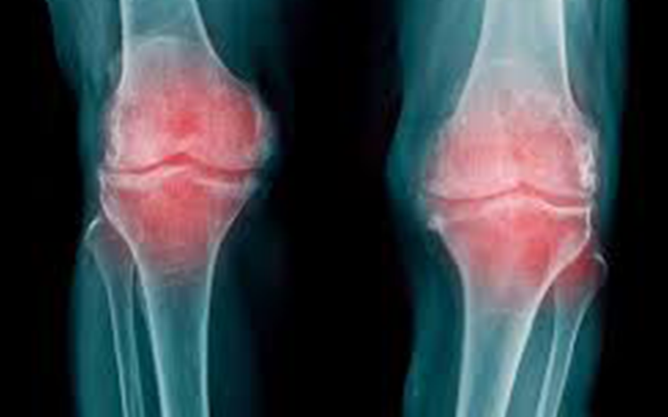 Artrosis (Osteoartritis)