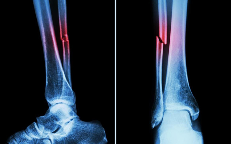 Fracturas óseas y luxaciones