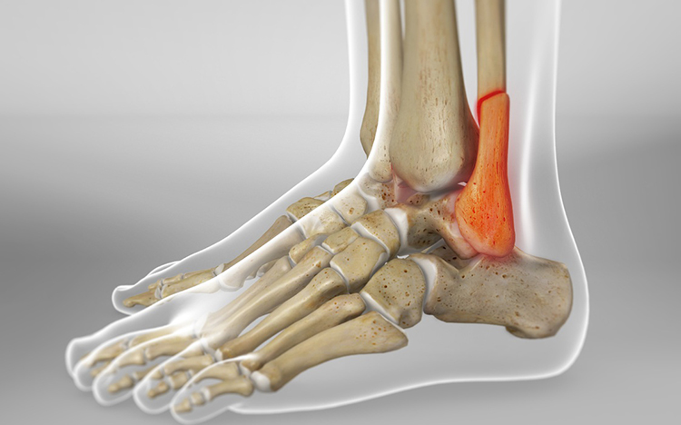 Cirugía de fracturas